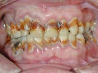 tobacco damage