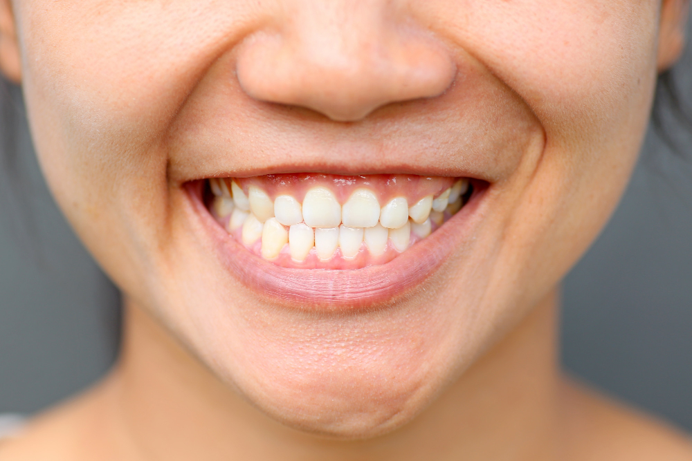 Close-up of patient smile showing deep bite overbite interference before correction