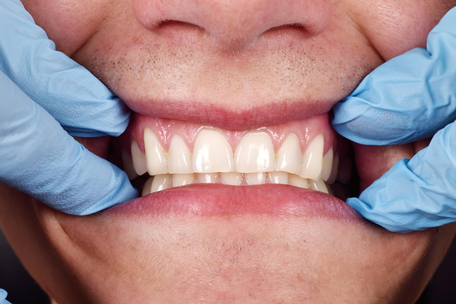 Dental clinical exam showing patient gums and tooth alignment