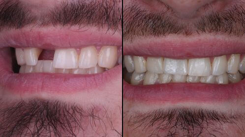 Before and after result of missing upper side tooth restored with dental implant