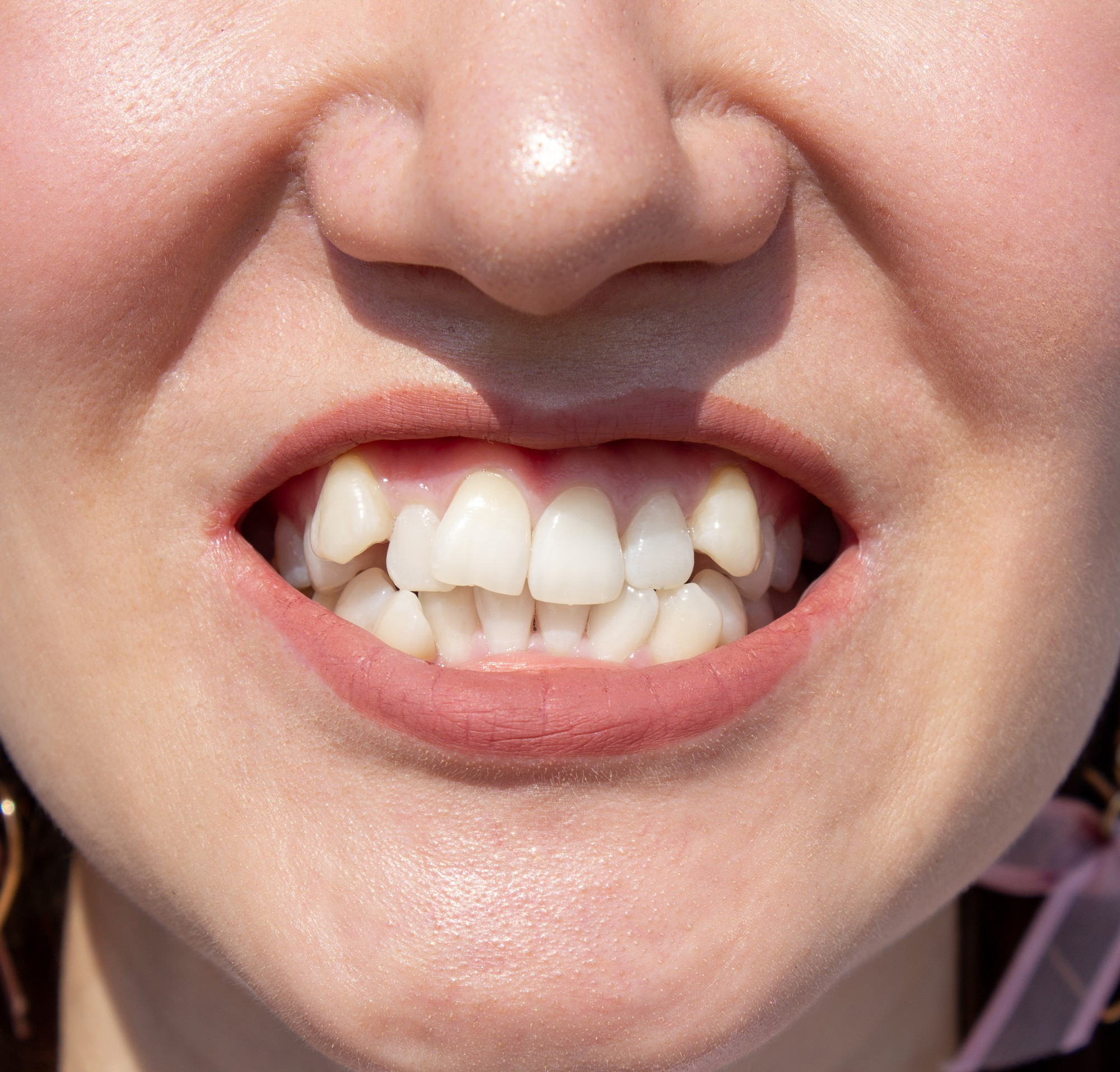 Close-up of severe dental crowding and twisted front teeth before orthodontic treatment