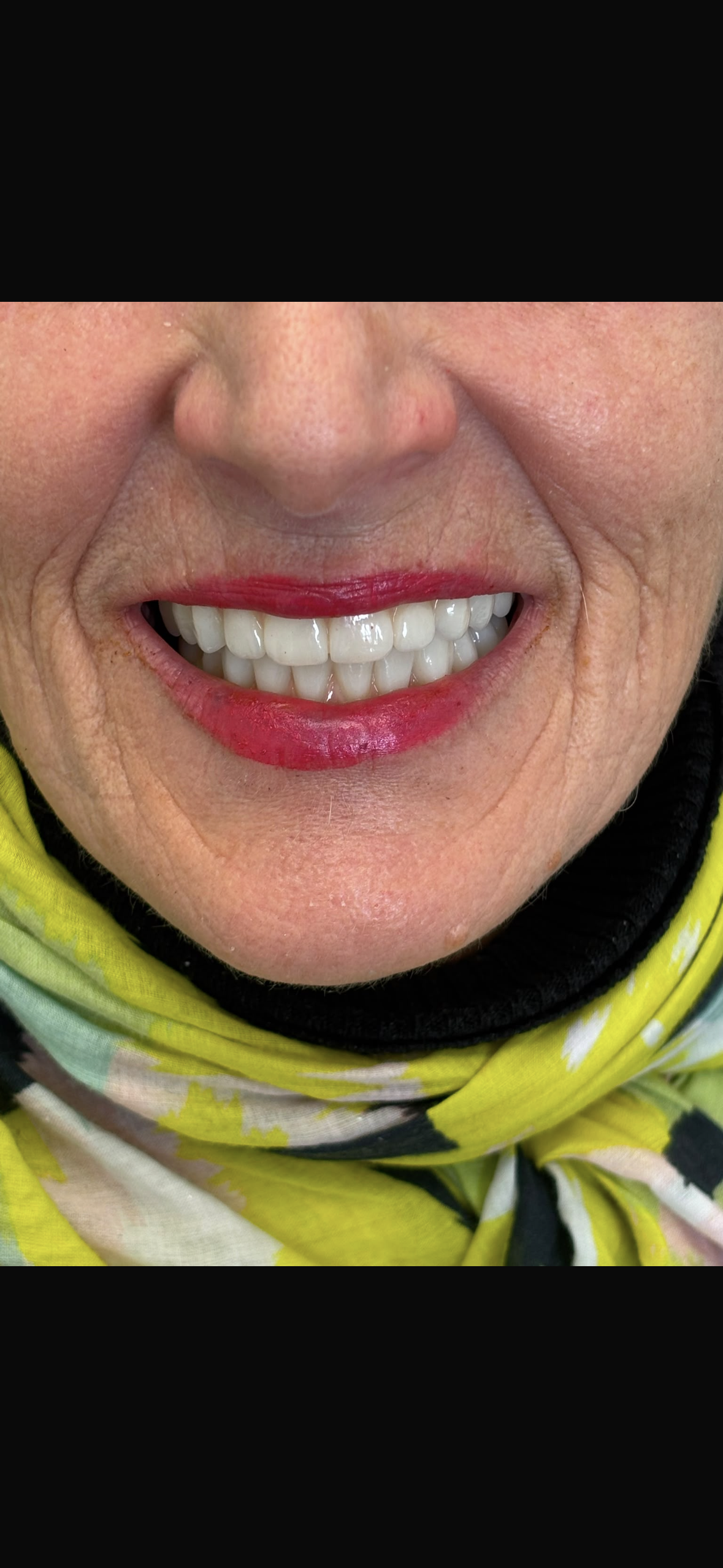 Smiling patient wearing bright lipstick with full restored upper teeth