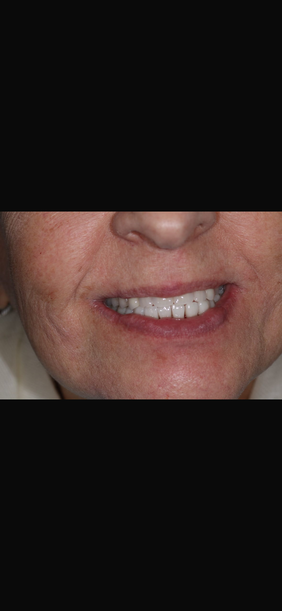 Patient showing restored straight upper teeth after dental implant fitting