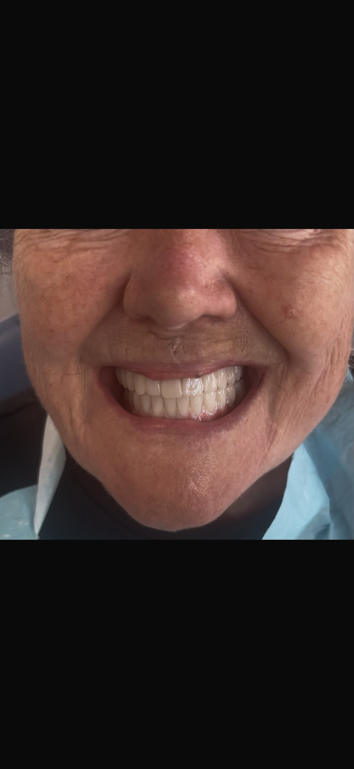 Older female patient with a full set of restored, straight white teeth