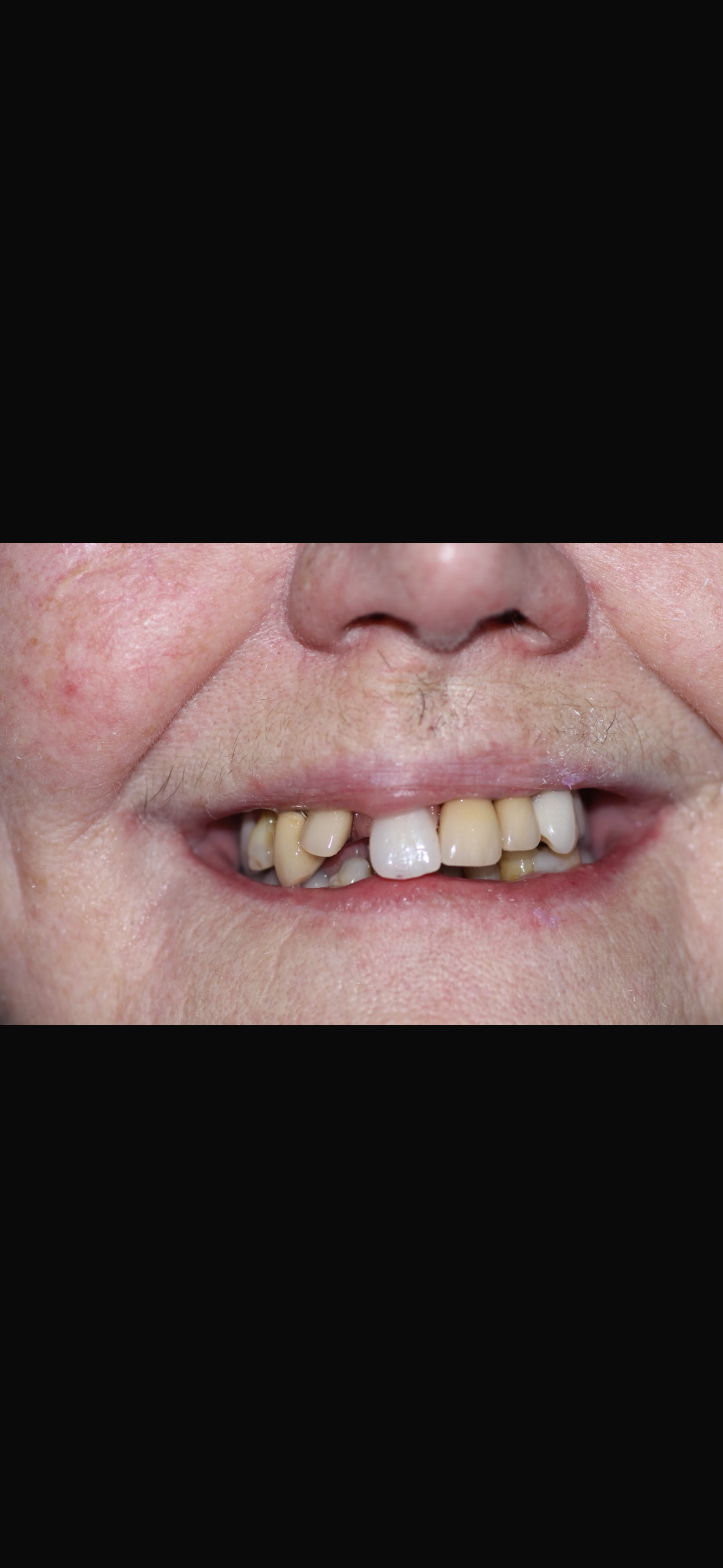 Older female patient with missing, discoloured, and worn front teeth before treatment