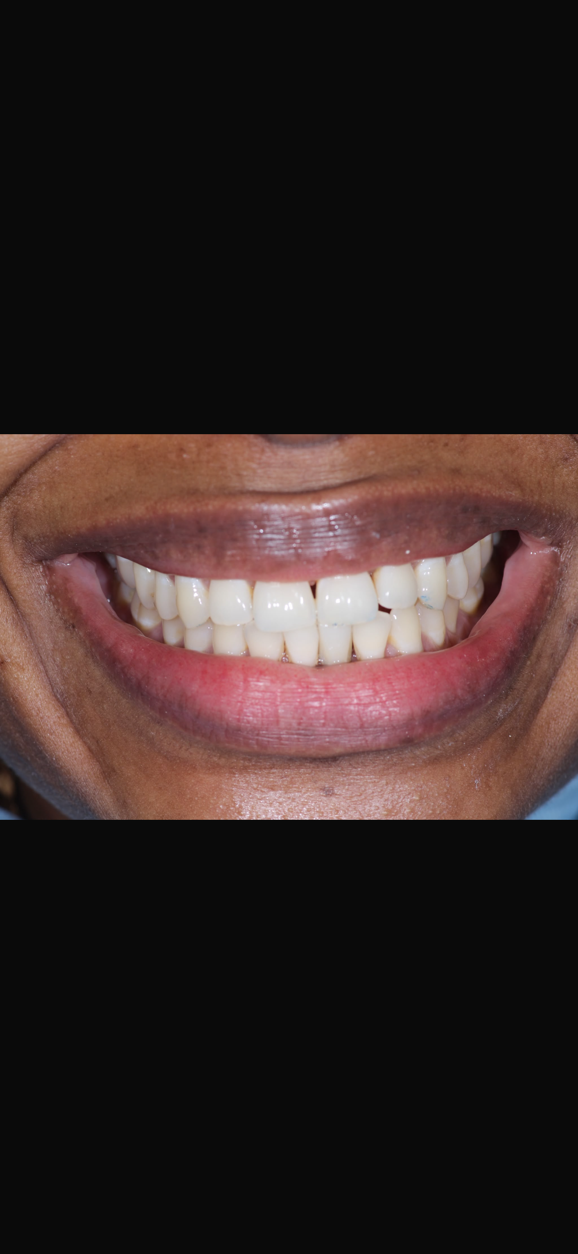 Straight white teeth and healthy gums after dental treatment at Surbiton Dental