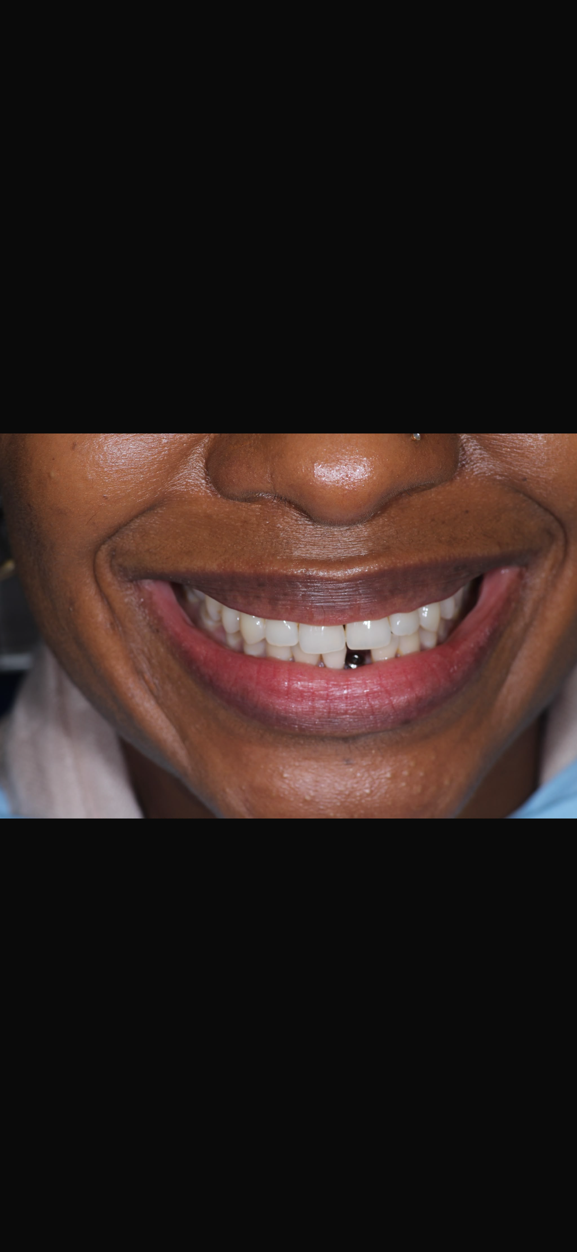 Close-up of patient smile showing a missing front tooth gap before restorative treatment