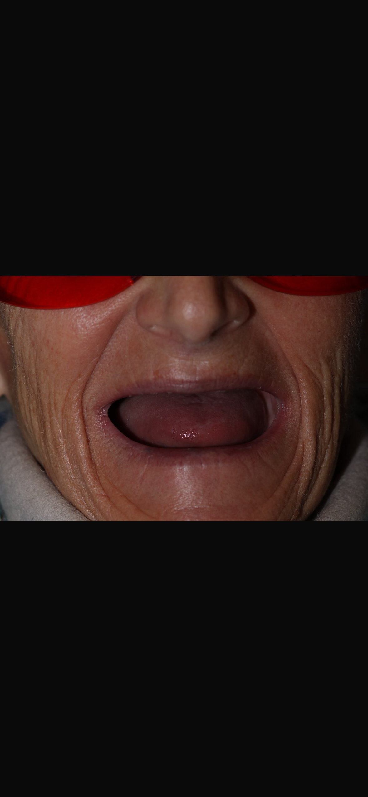 Patient with complete upper tooth loss prior to dental implant treatment