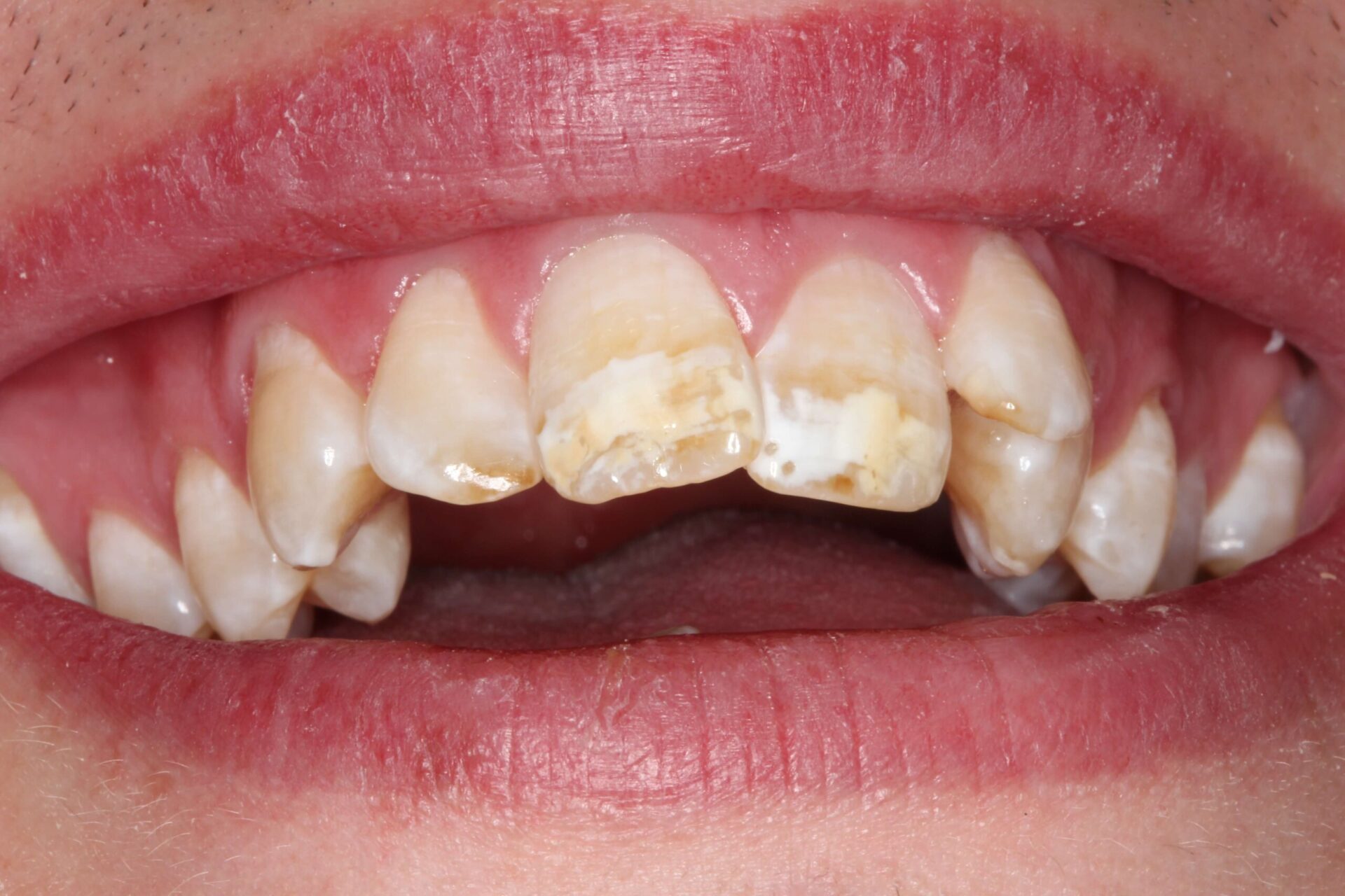 Close-up of chipped and discoloured upper front teeth before cosmetic repair
