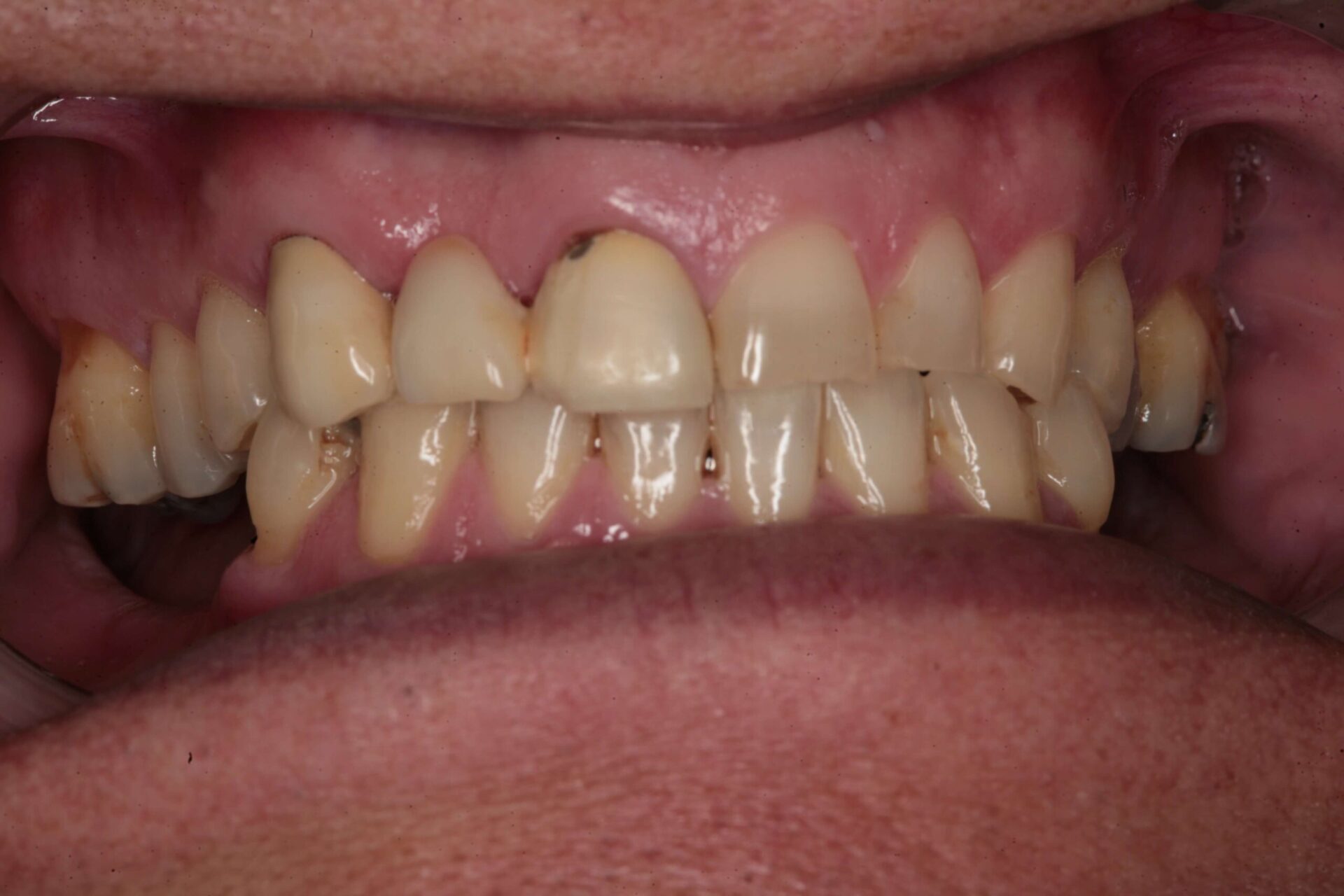 Close-up of restored natural-looking upper front tooth and improved bite alignment