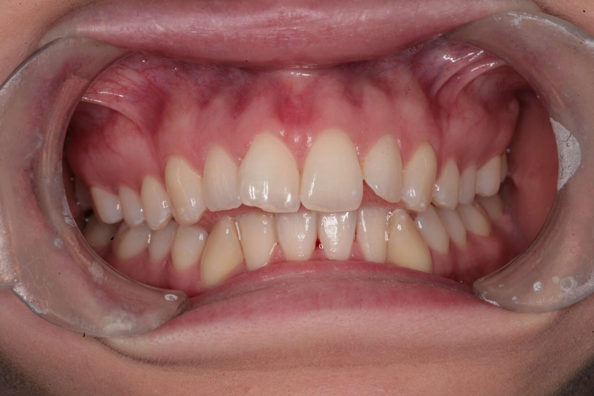Clinical photograph showing slightly misaligned front teeth and chipped edges before treatment