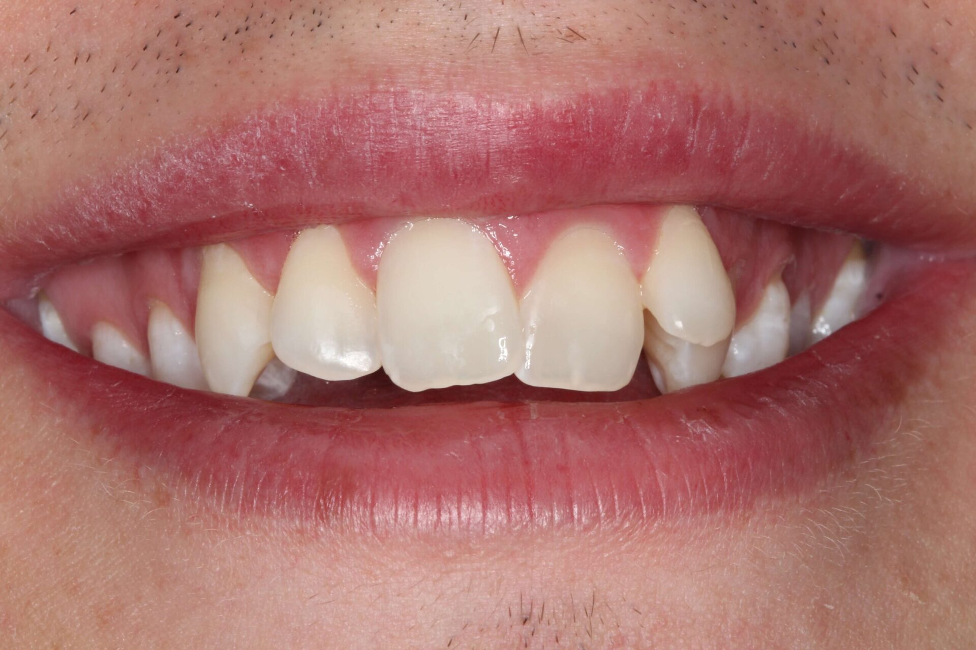 Close-up of restored upper front teeth after composite bonding treatment