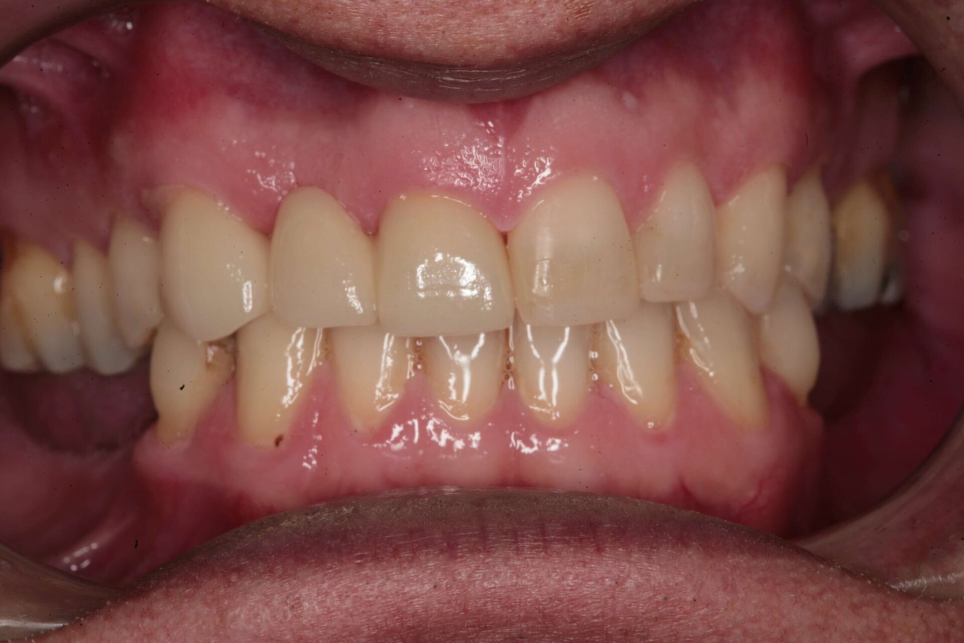 Close-up of discoloured upper front tooth and uneven bite before crown restoration