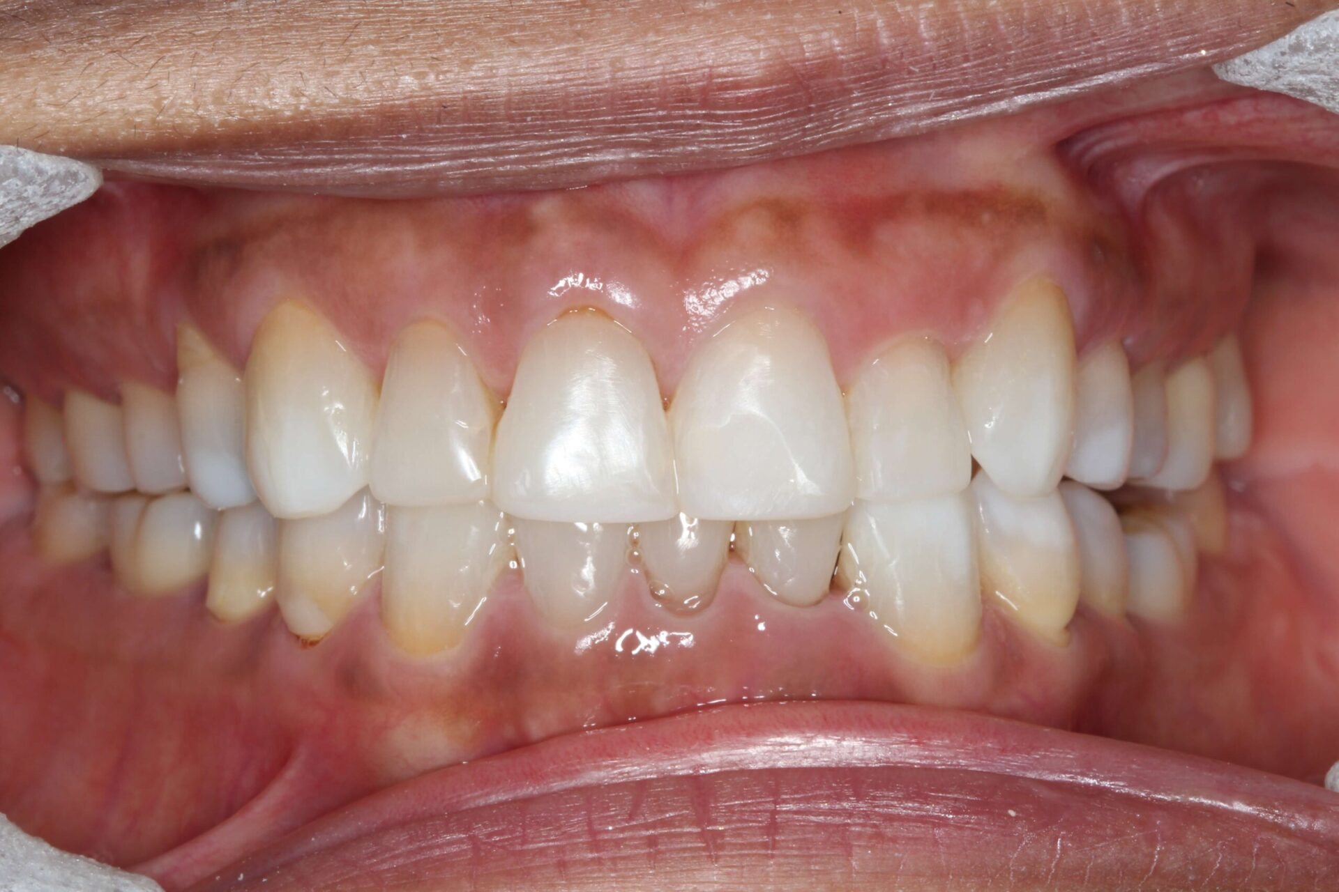Clinical view of perfectly aligned upper and lower teeth after orthodontic treatment