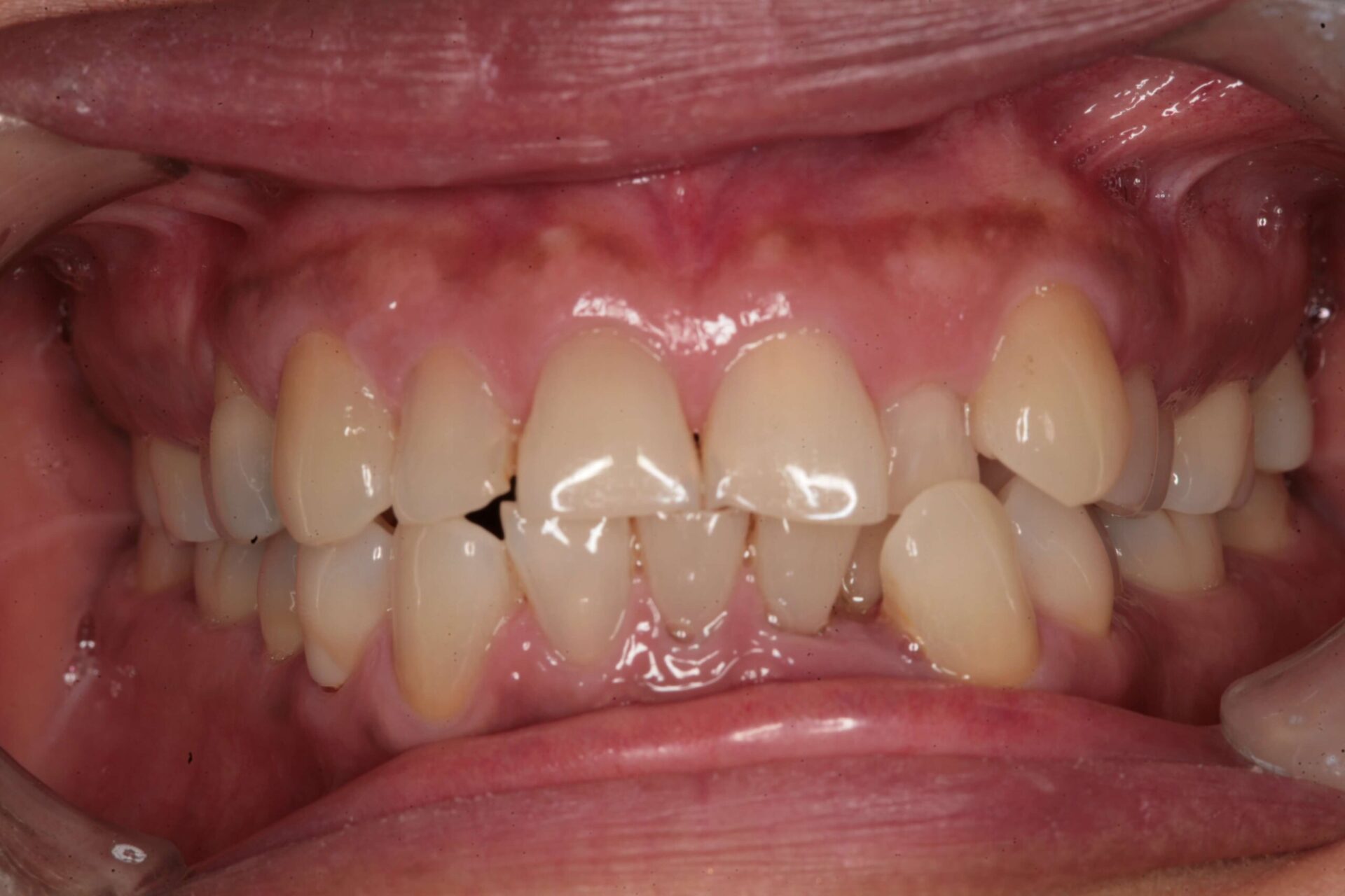 Clinical view of severely crowded and misaligned upper and lower teeth before aligners