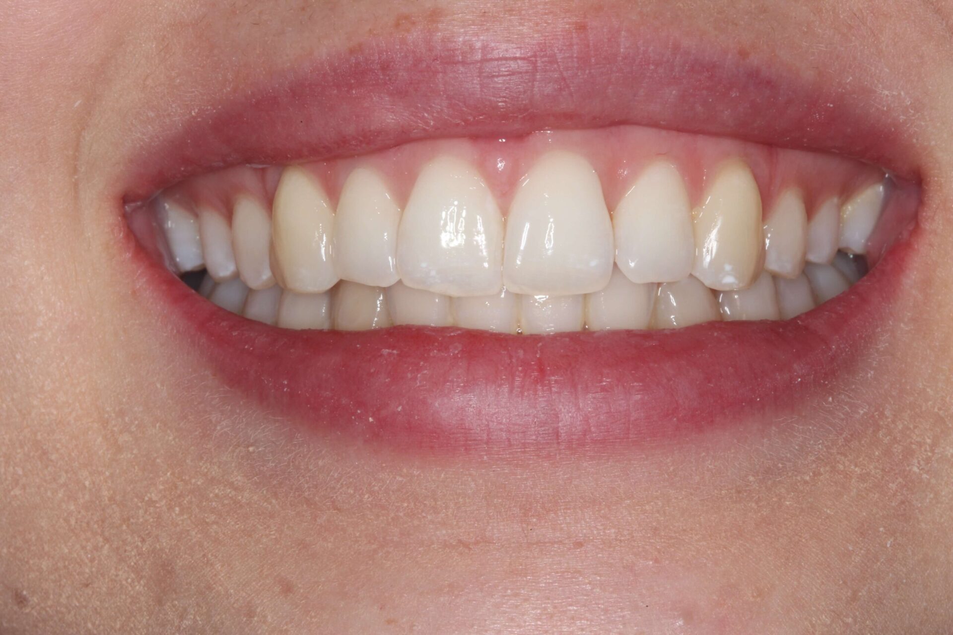 Close-up of a female patient smiling with straight white teeth after treatment at Surbiton Dental