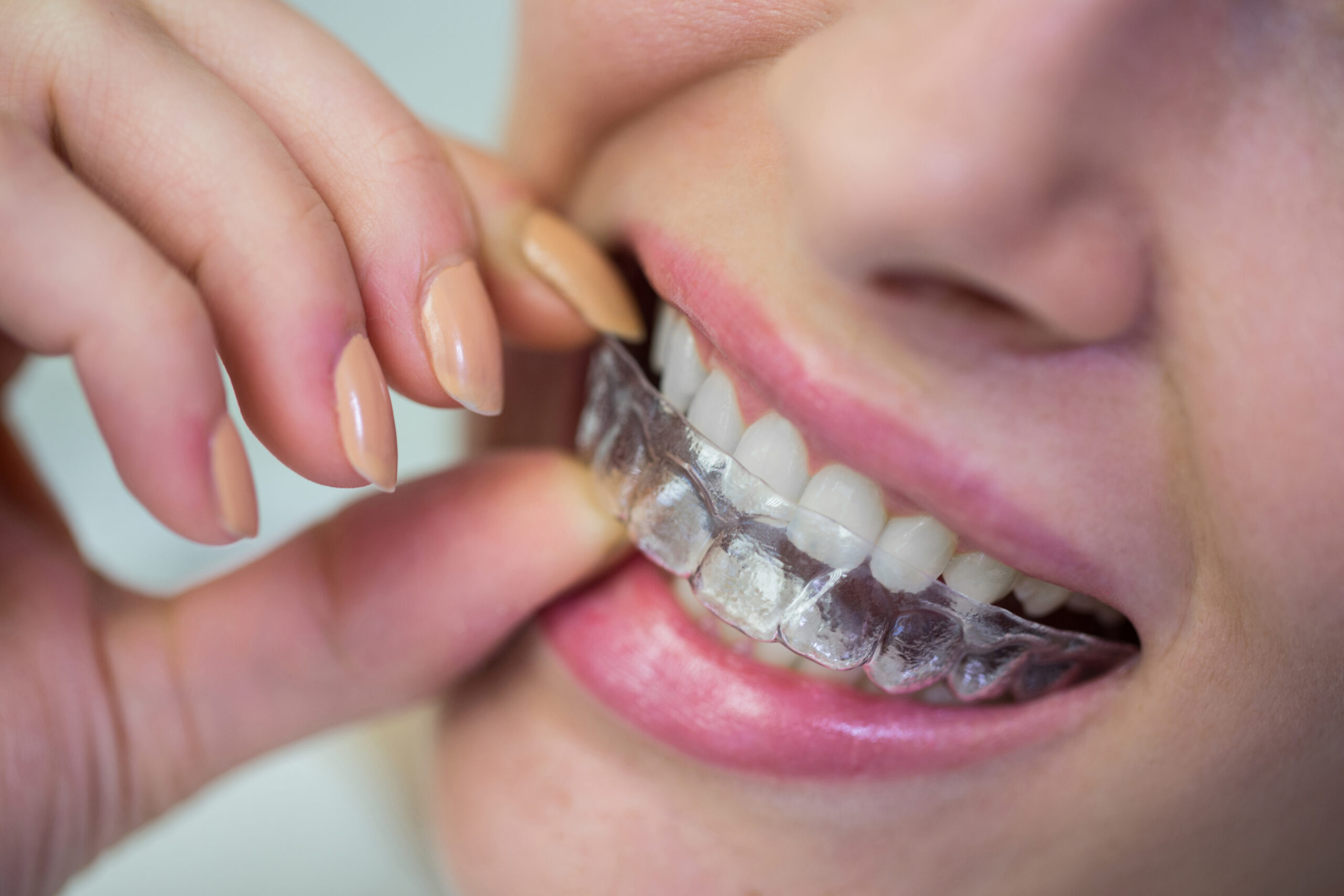 Patient inserting a clear Invisalign aligner over top teeth