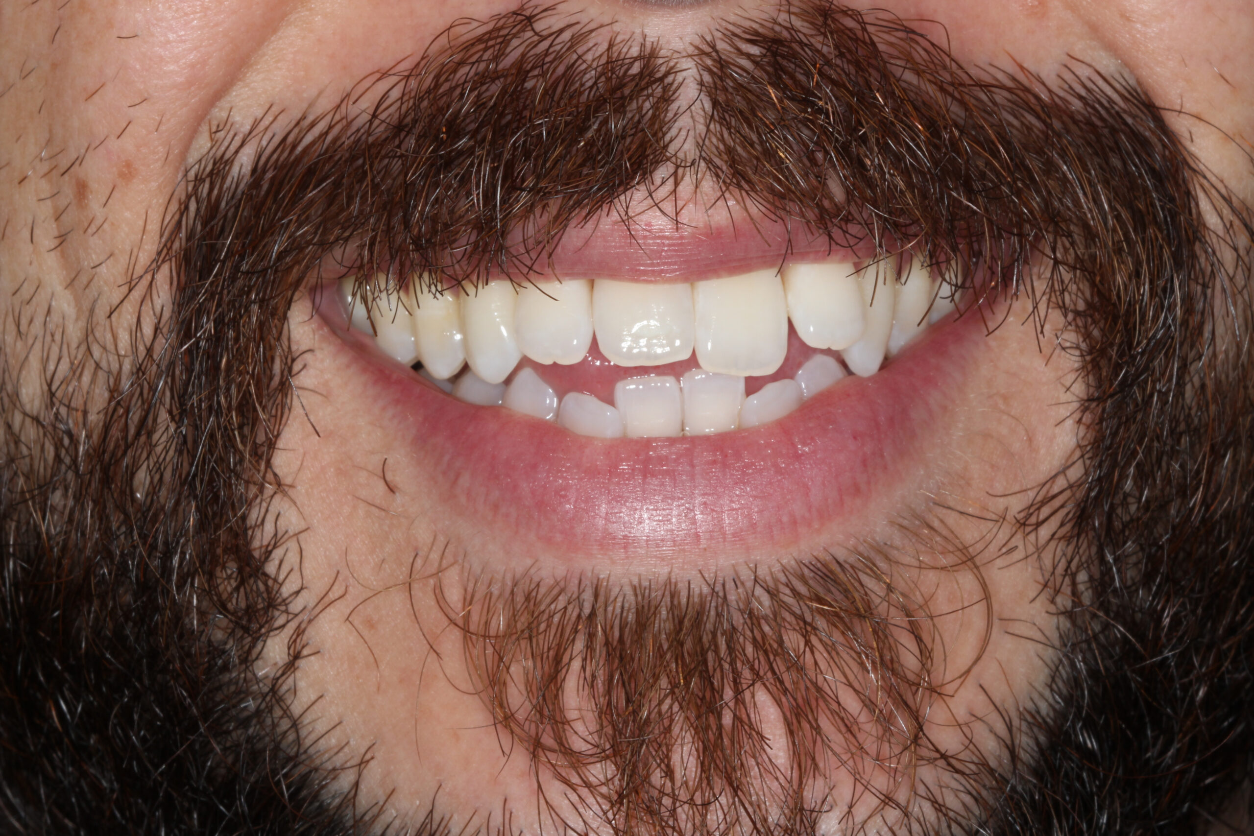 Male patient with misaligned teeth before Invisalign treatment