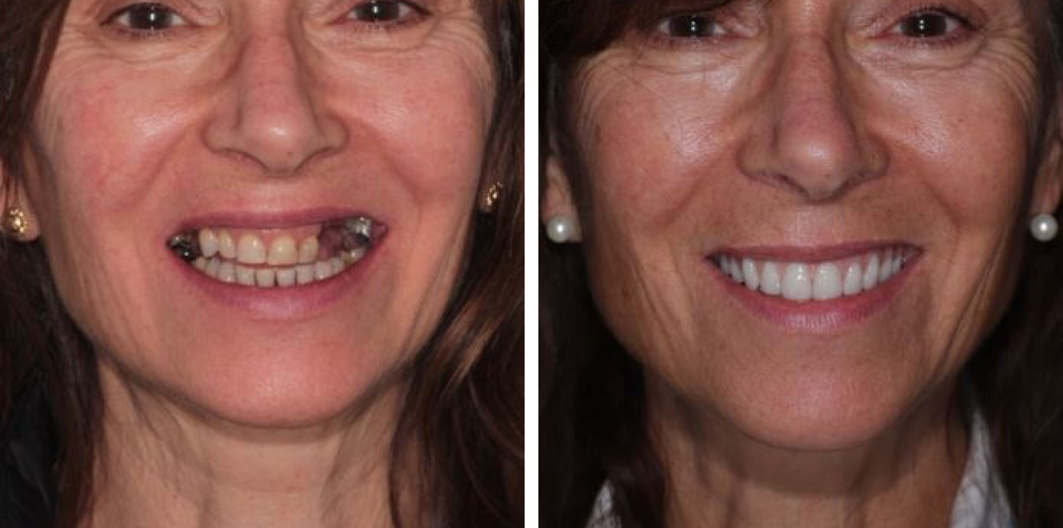 Before and after comparison of a female patient receiving a full smile makeover