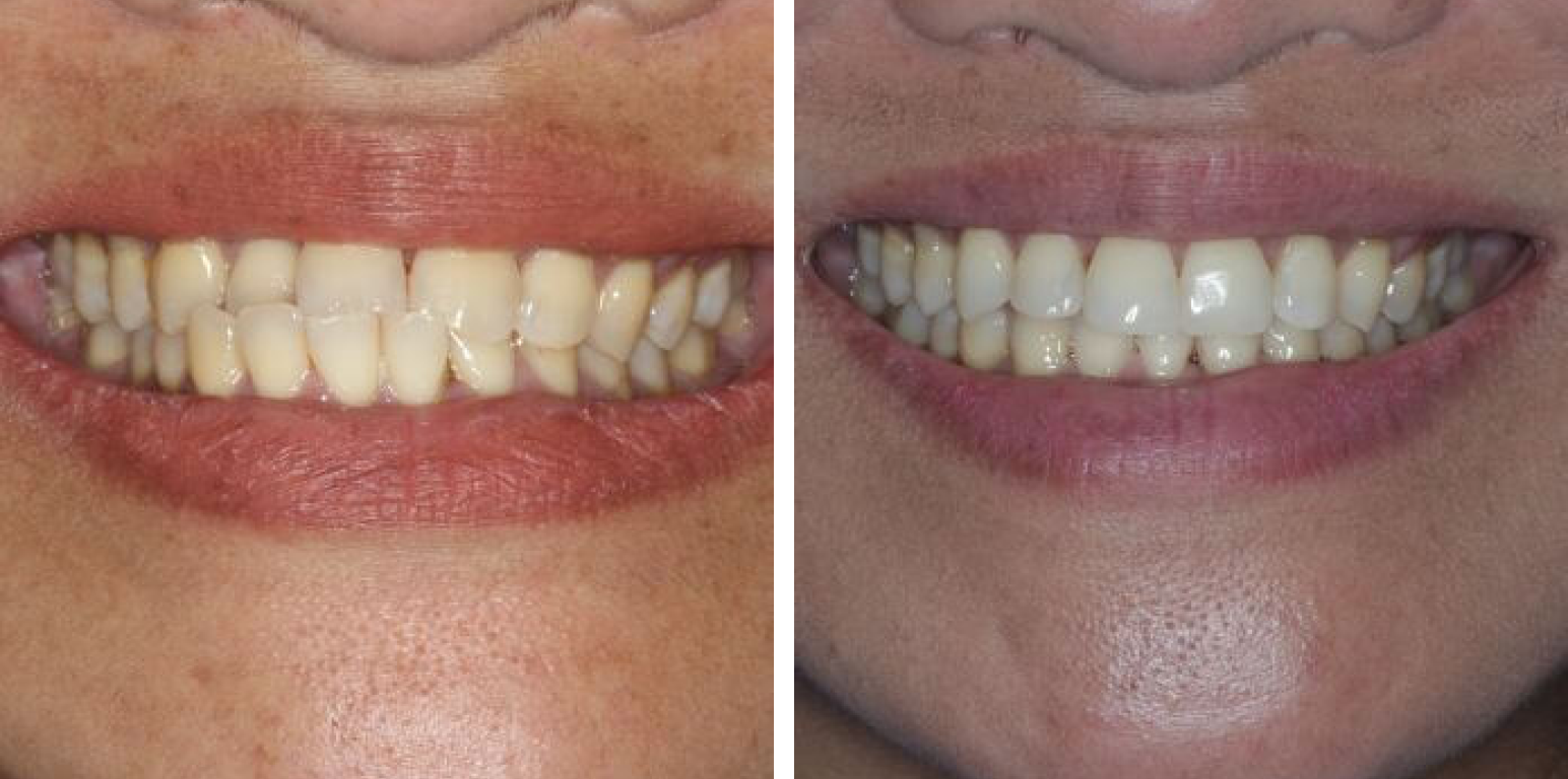 Side-by-side comparison of teeth before and after clear aligner treatment