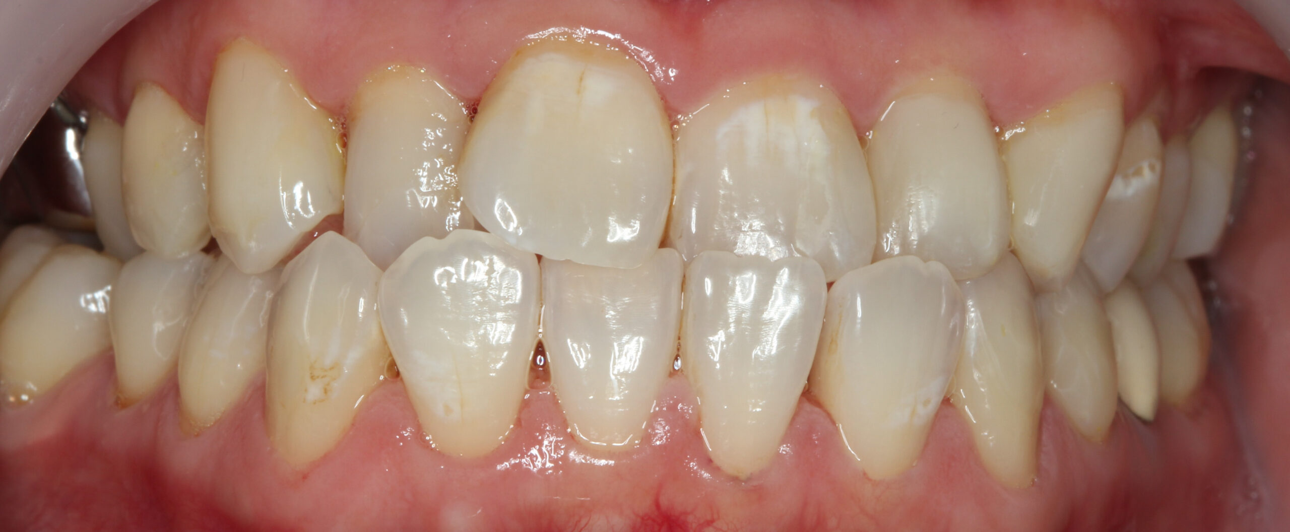 Close-up clinical photograph of crooked front teeth before treatment