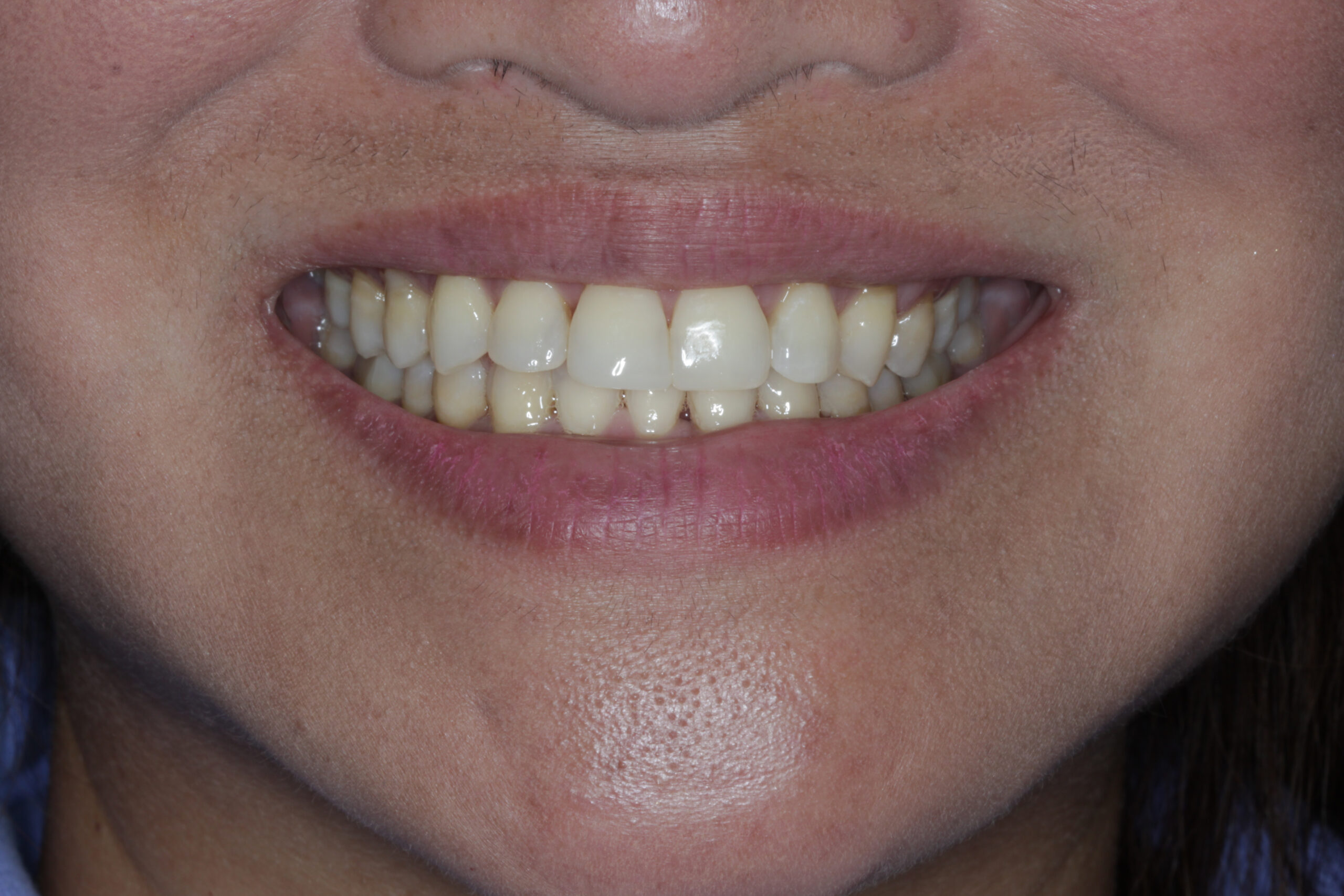 Female patient showing aligned teeth and bright smile after Invisalign treatment