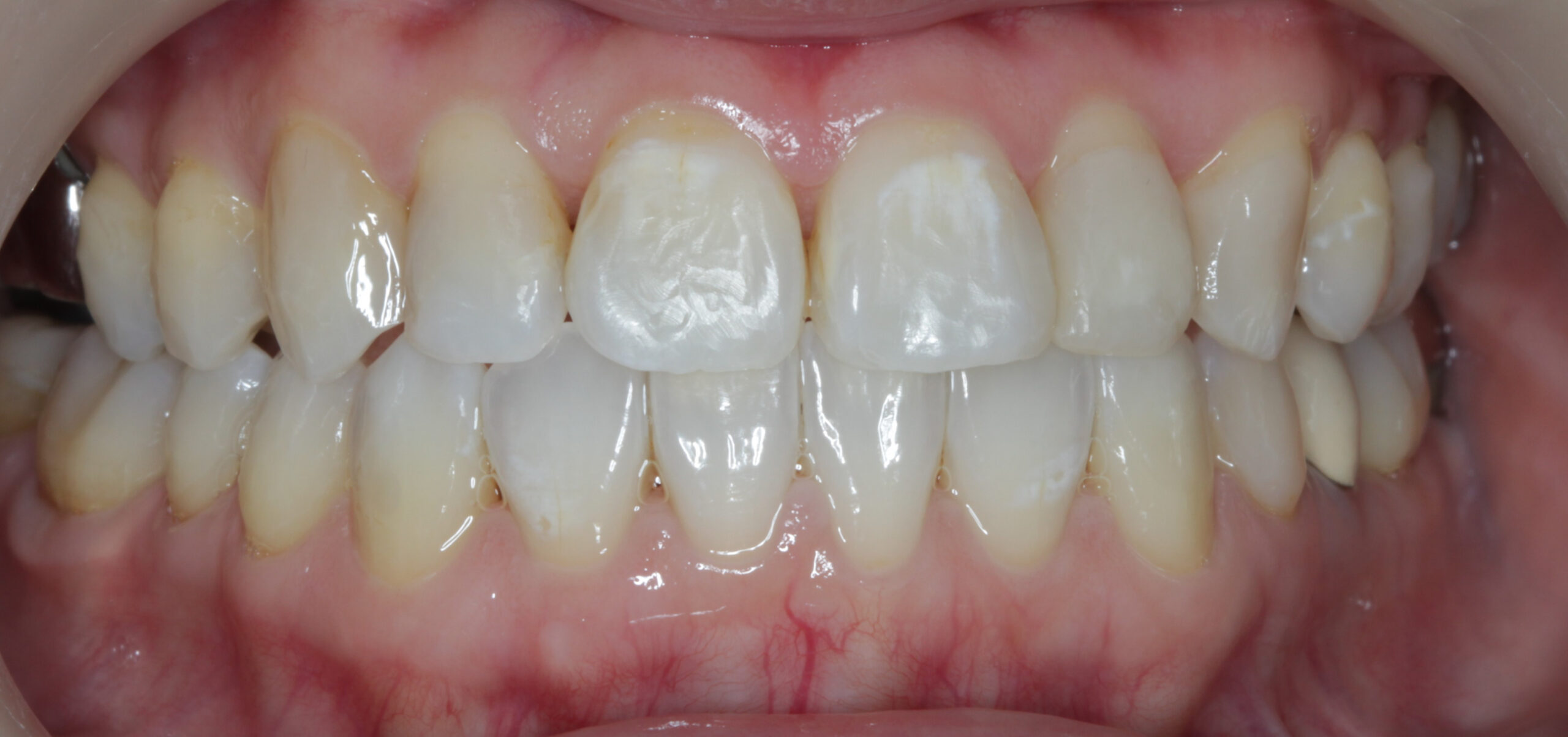 Close-up clinical photograph of straight teeth following clear aligner therapy