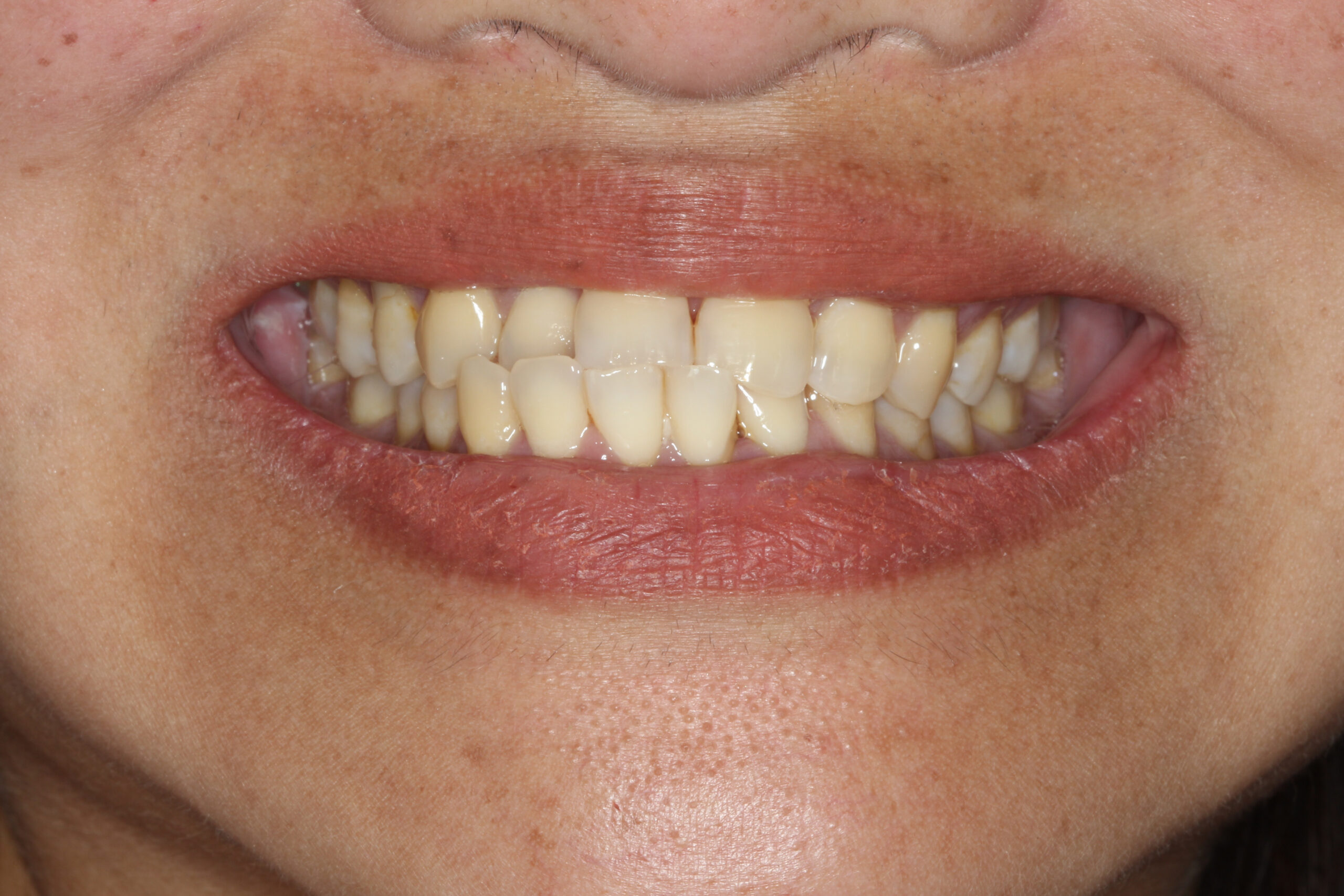 Female patient smile showing slightly uneven alignment before clear aligners