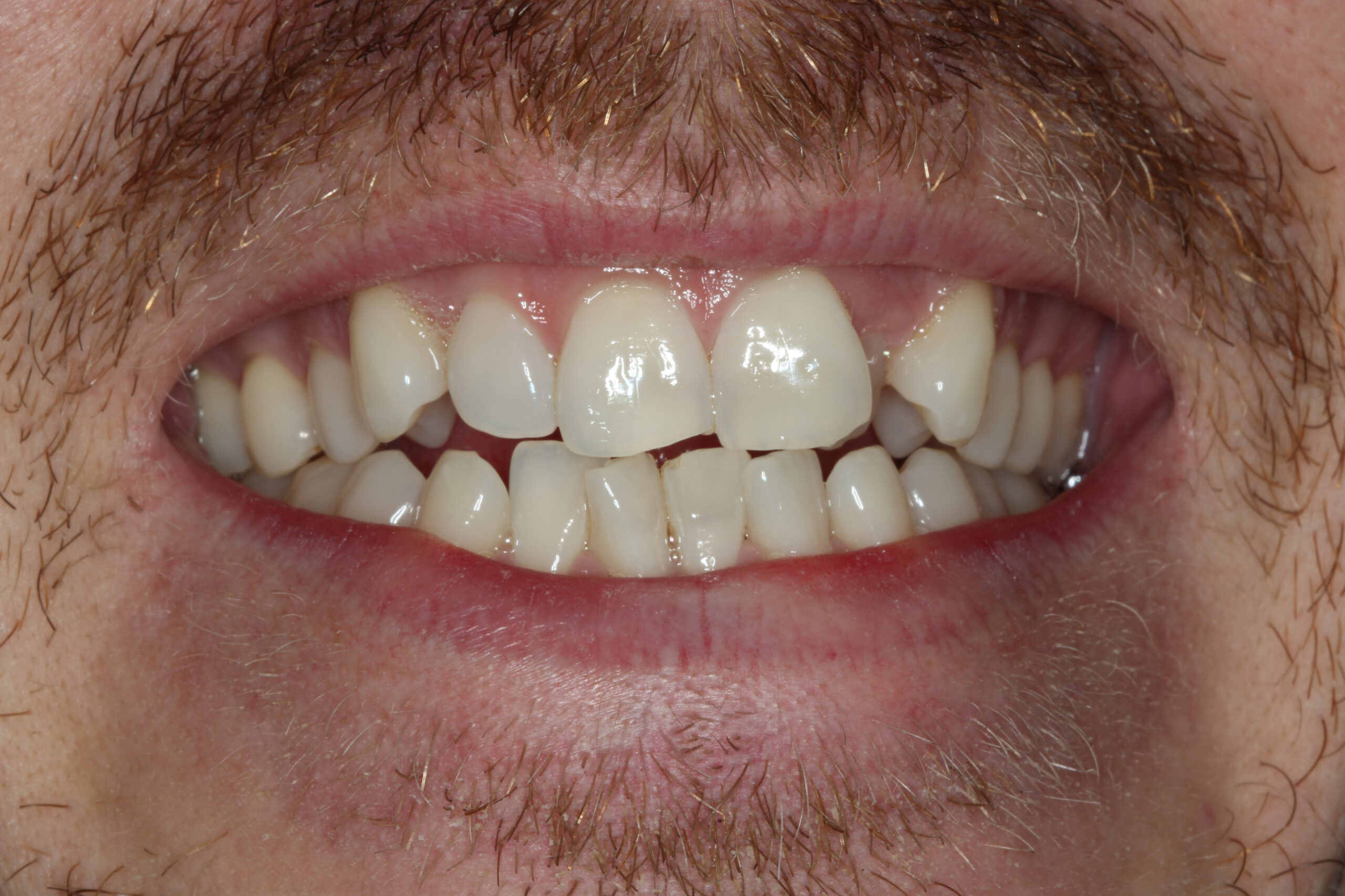Male patient showing crowded and overlapping teeth before Invisalign treatment