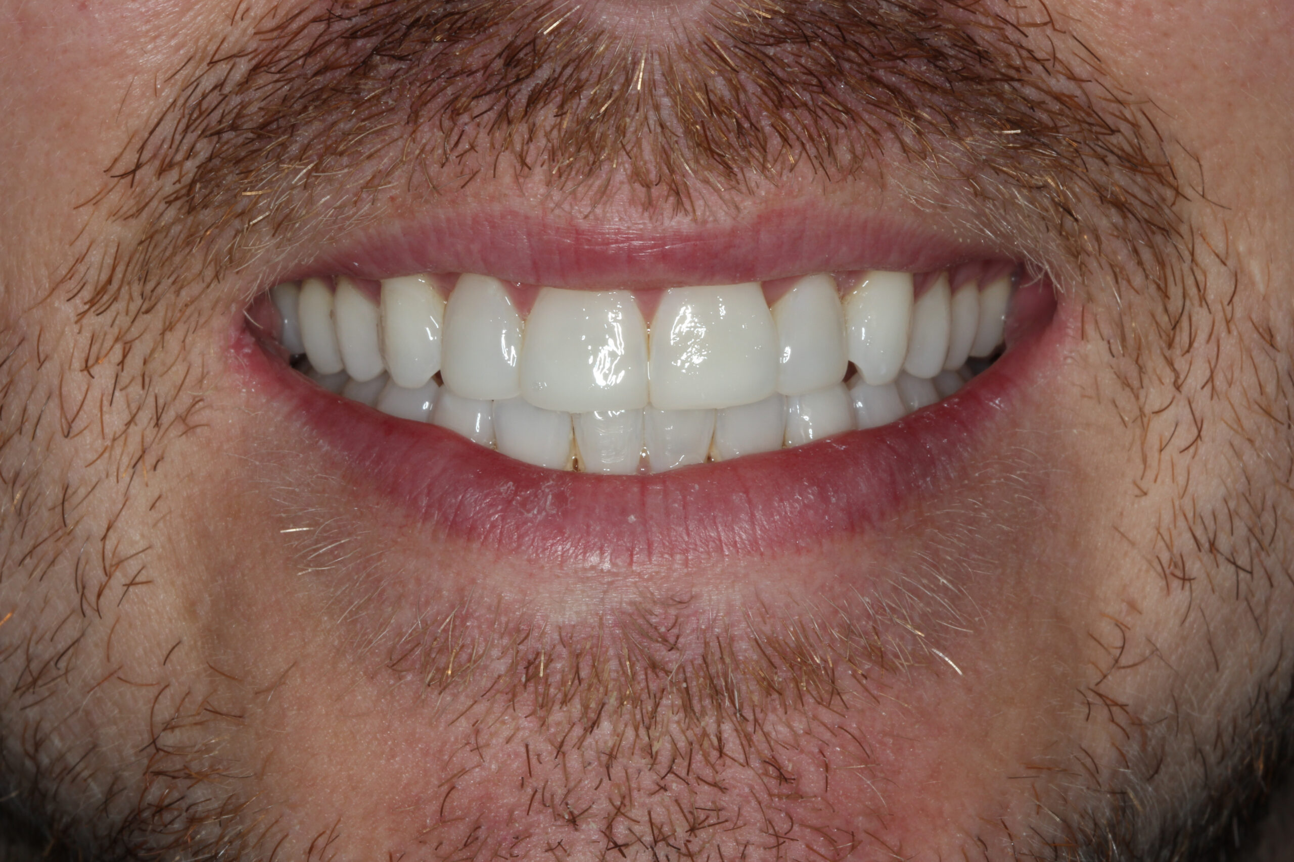 Close-up of male patient smiling with straight white teeth after dental treatment
