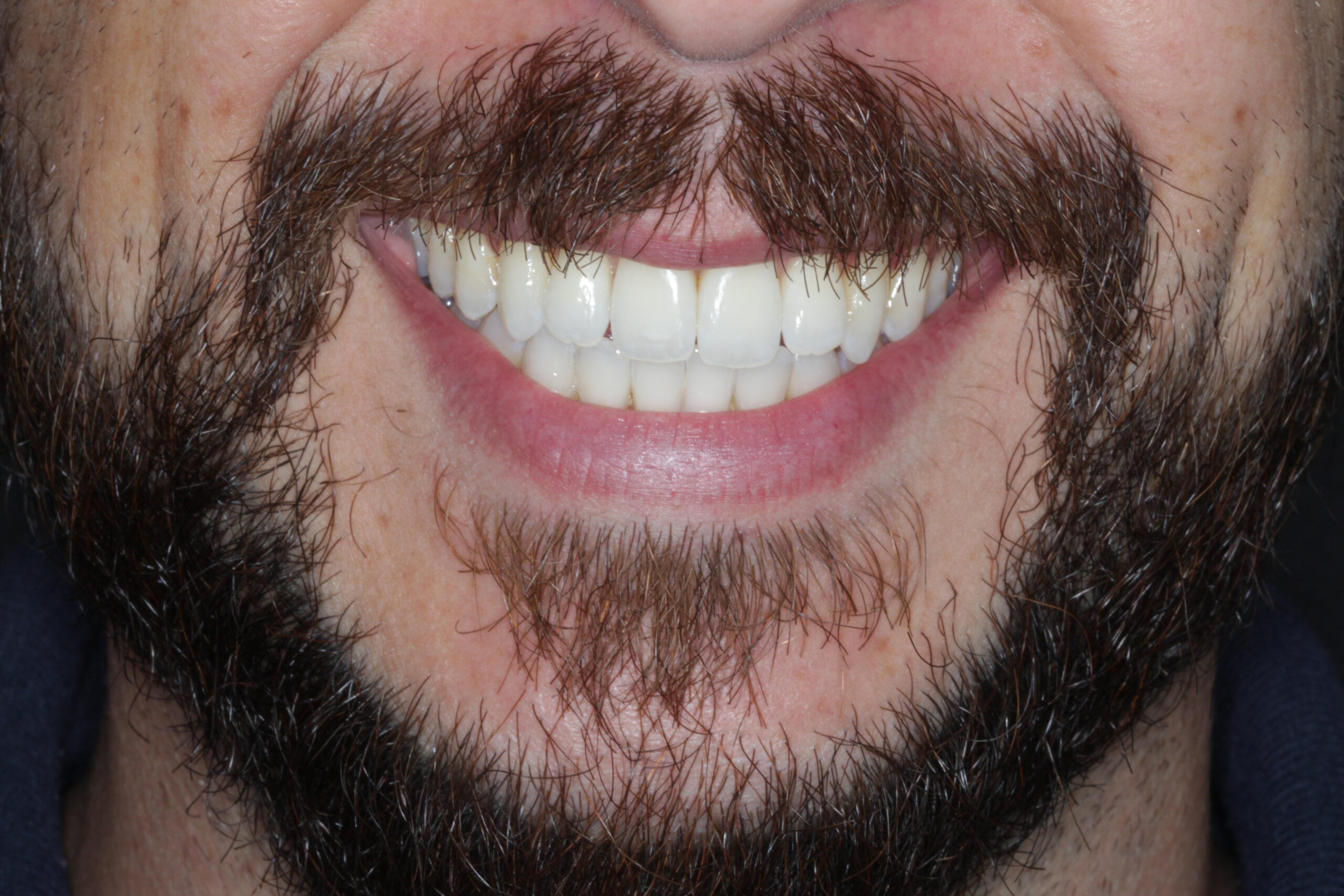 Straight white teeth after Invisalign treatment at Surbiton Dental near Tolworth