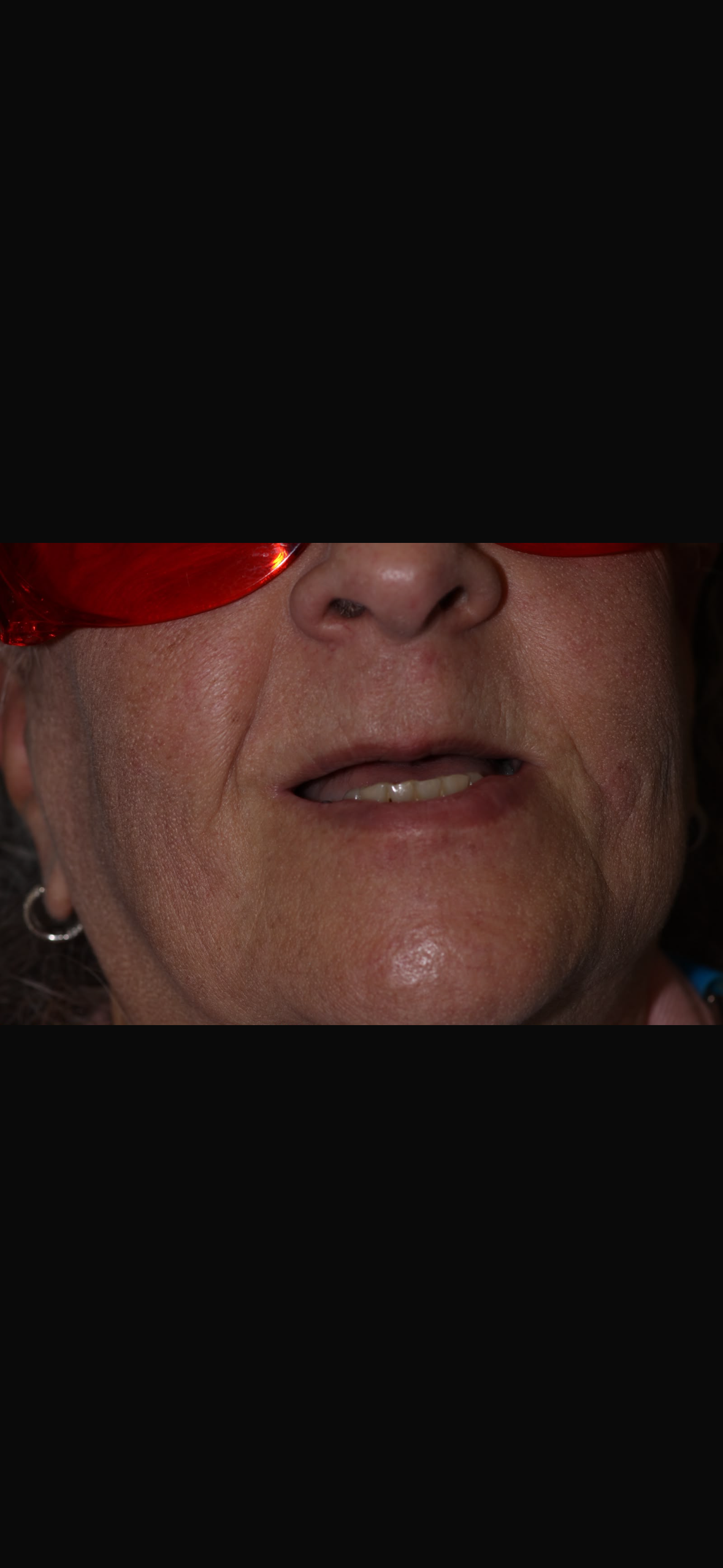 Close-up of patient missing upper front teeth before dental implant procedure