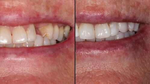 Before and after comparison of male patient smile transformation with Invisalign