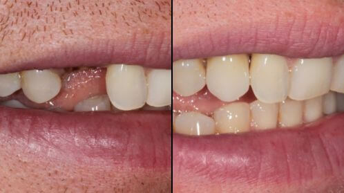 Before and after result of missing tooth gap restored with natural-looking crown