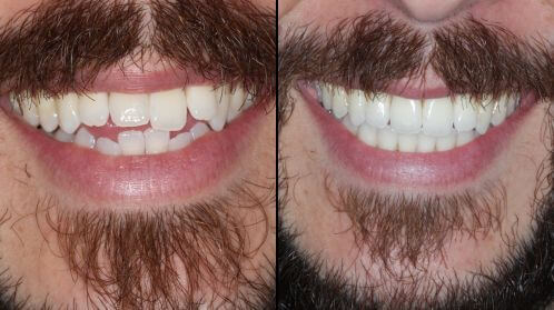 Side-by-side before and after comparison of male patient smile straightened with Invisalign